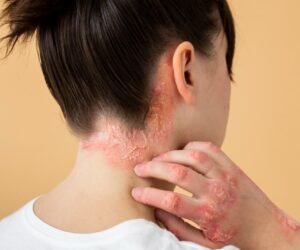Fungal Skin Infections Fungal Skin Infections