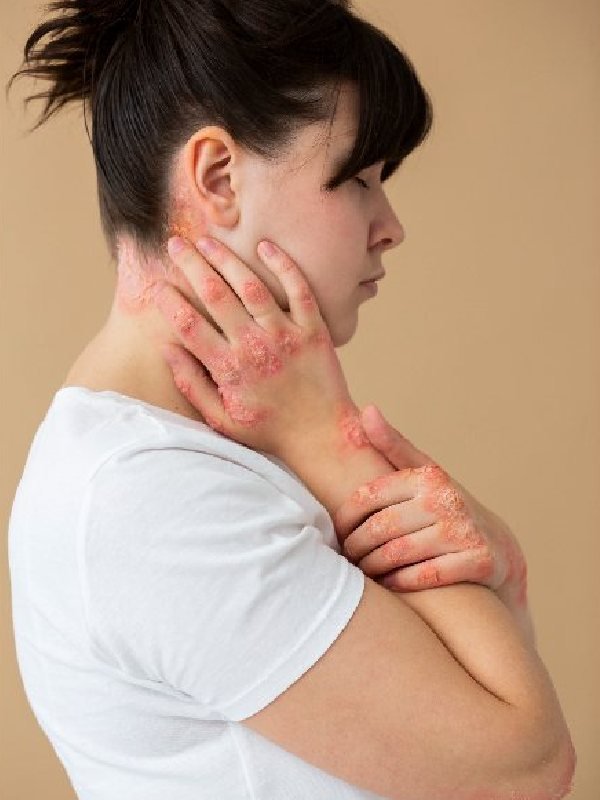 Psoriasis Psoriasis