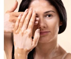 Vitiligo Vililigo